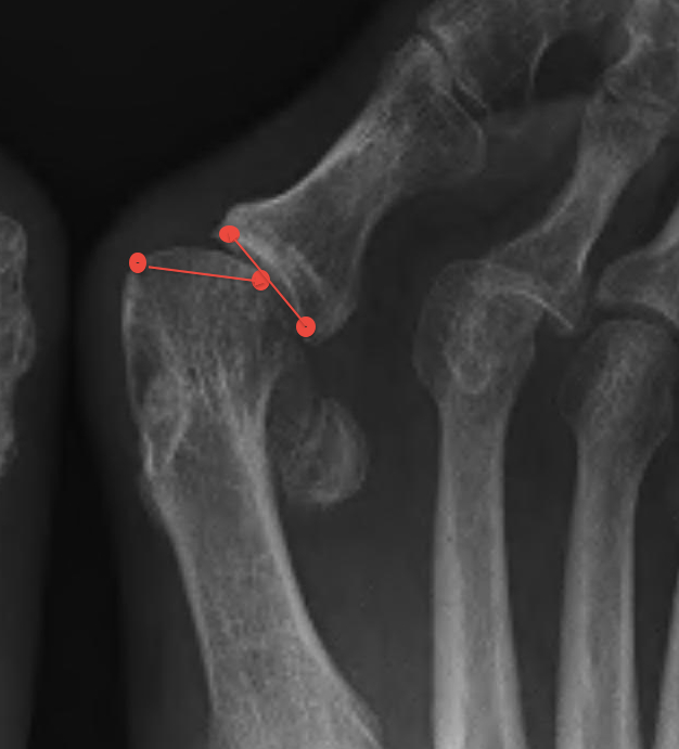 Hallux Valgus Incongruent Joint